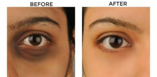 How To Remove Eyes Dark Cycle In Hindi