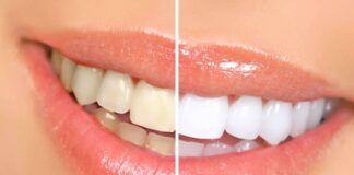 Naturally Whiten Your Teeth at Home Hindi