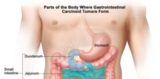 Appendix Cancer Symptoms and Treatment
