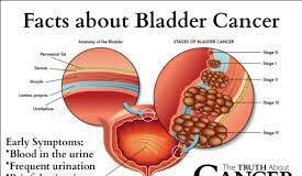 Bladder Cancer Symptoms and Treatment