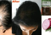 Onion Juice For Hair Growth (प्याज का रस)