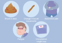 Colon Cancer Symptoms and Treatment