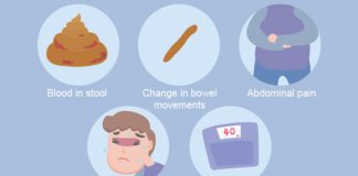 Colon Cancer Symptoms and Treatment