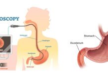 Duodenal Cancer Symptoms and Treatment