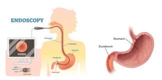 Duodenal Cancer Symptoms and Treatment