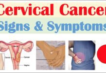 Cervical Cancer Symptoms and Treatment