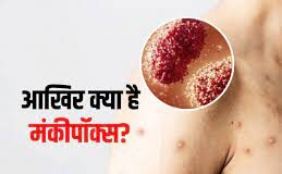 What is Monkeypox क्या है इसके लक्षण in Hindi