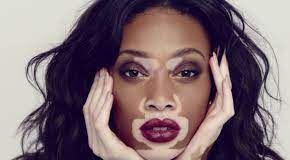 Winnie Harlow Biography, Age, Height, Model and Boyfriend